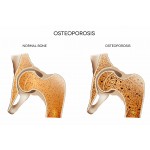 Botdensiteit & Botproblemen